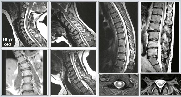 Upright MRI Spine Imaging